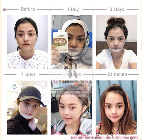 ศัลยกรรมปรับโครงหน้า 3 จุด ลดโหนกแก้ม ตัดกราม และ วีไลน์ | Surgery Review