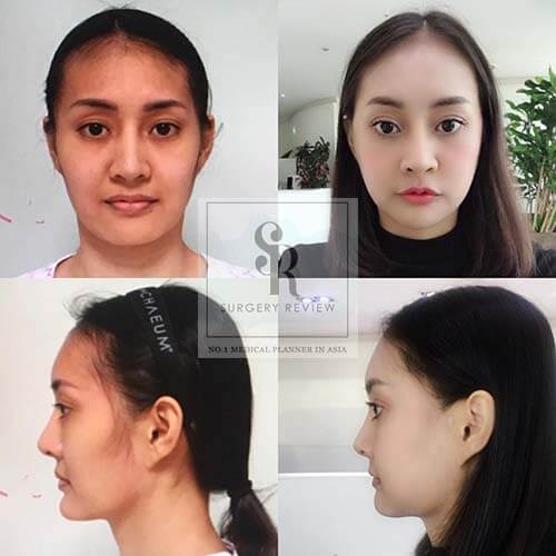 เสริมคาง ทำคางด้วยวิธีไหน แก้ไขปัญหาคางยื่น คางสั้น ดีที่สุด | Surgery  Review