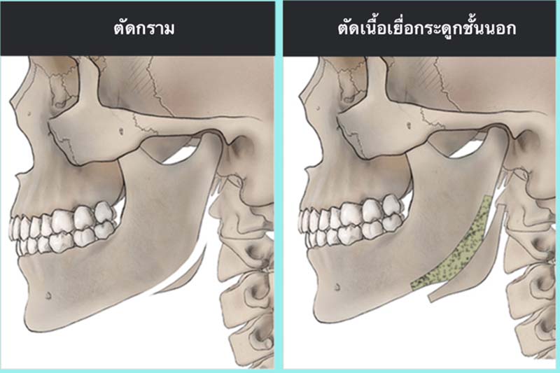 10 Checklist ก่อนตัดสินใจ ตัดกราม ราคา + รีวิว อัพเดท 2023 | Surgery Review