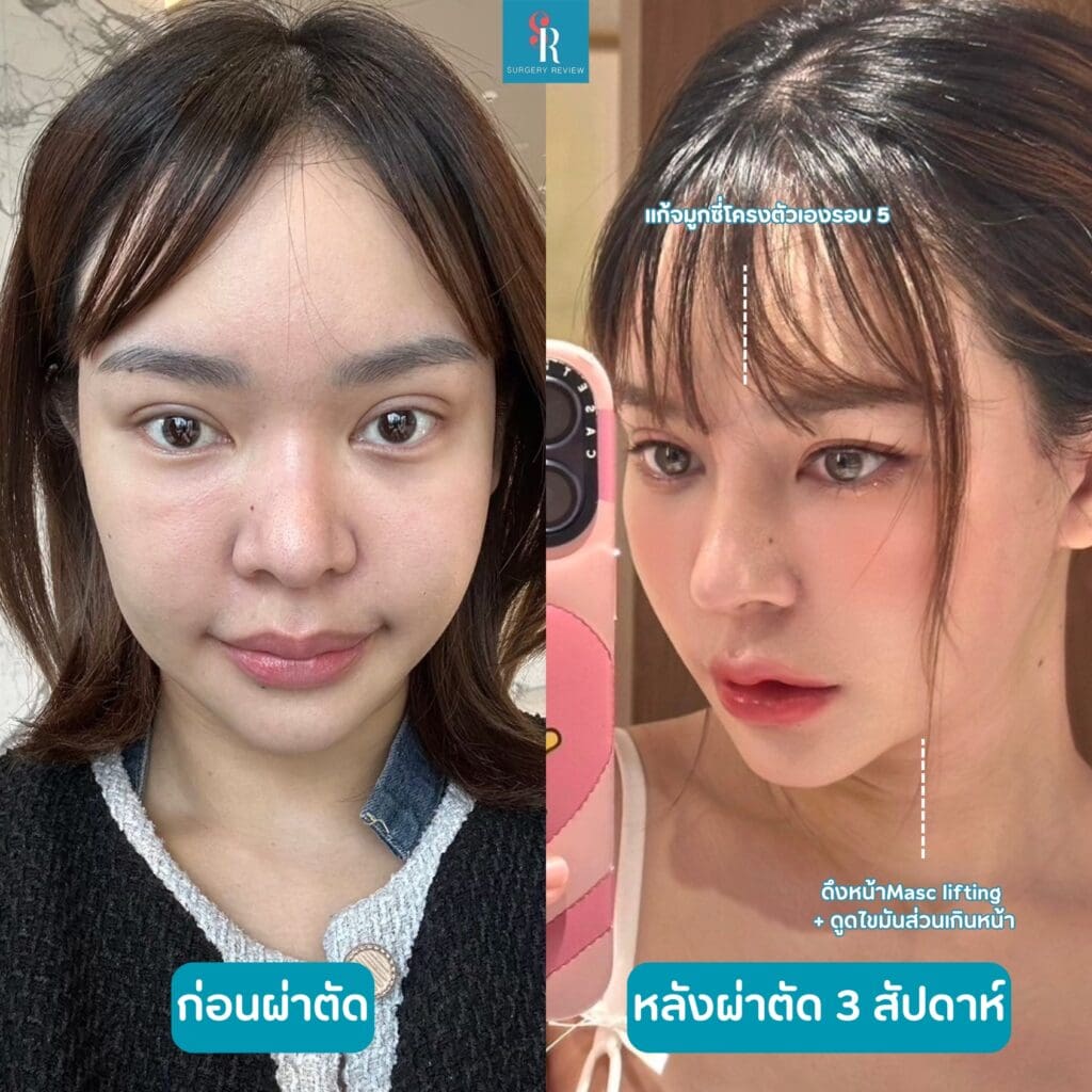 รีวิวศัลยกรรมรพ.บราวน์ จมูก+ดึงหน้า