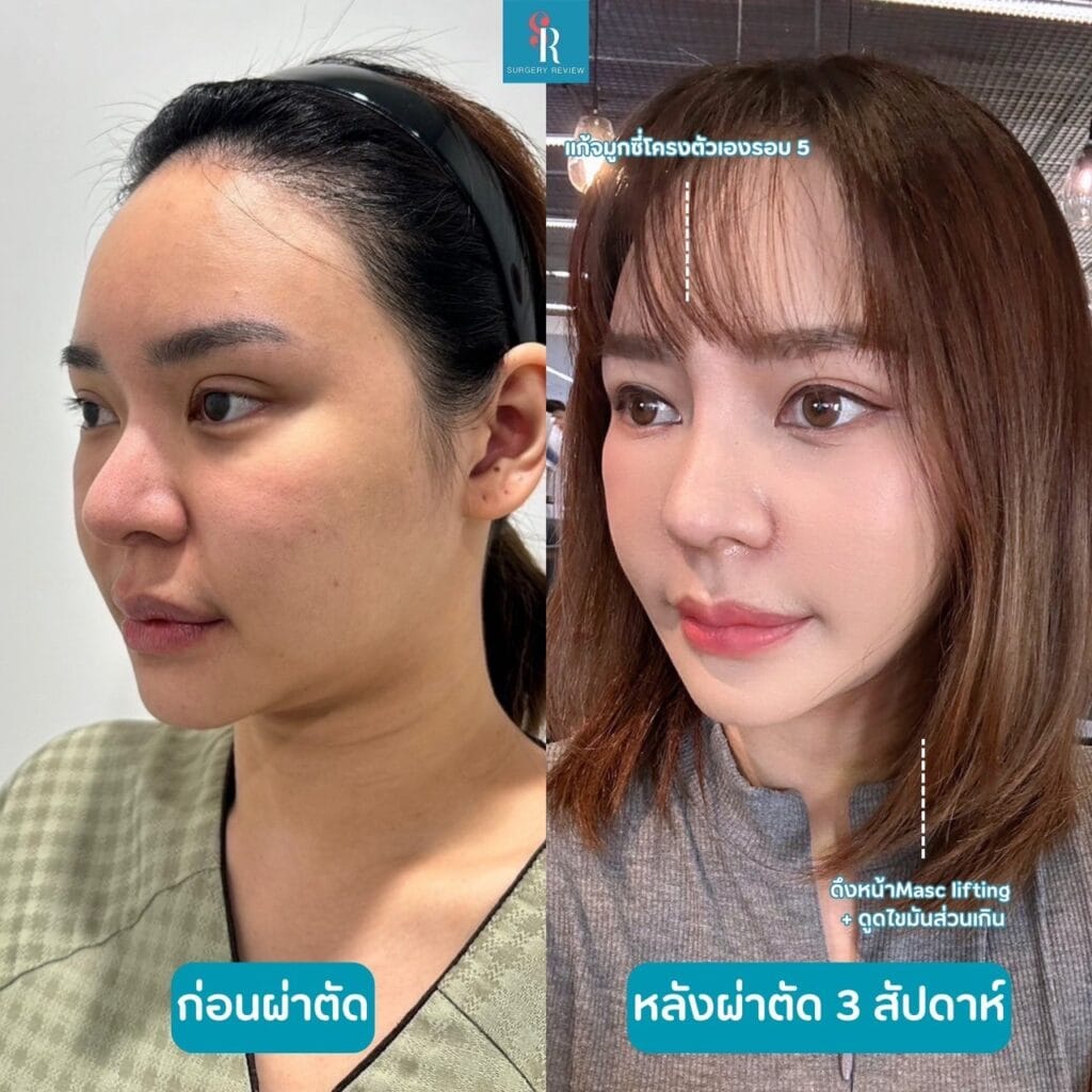 รีวิวศัลยกรรมรพ.บราวน์ จมูก+ดึงหน้า(1)