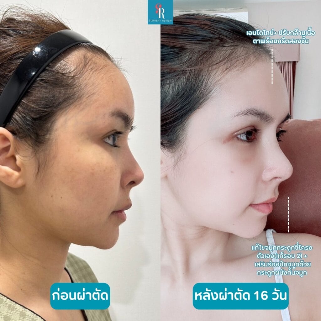 รีวิวศัลยกรรมรพ.บราวน์ จมูก+เอนโดไทน์