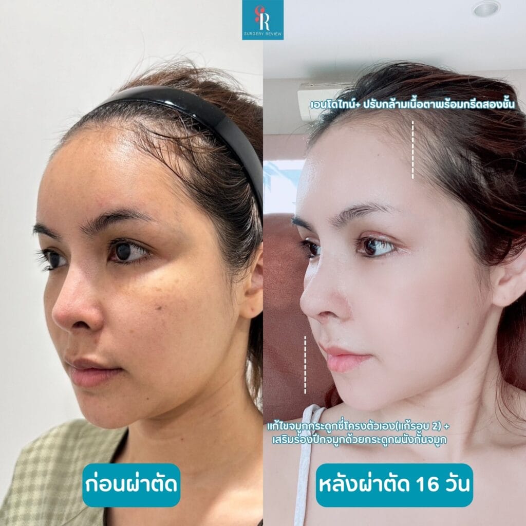 รีวิวศัลยกรรมรพ.บราวน์ จมูก+เอนโดไทน์(1)