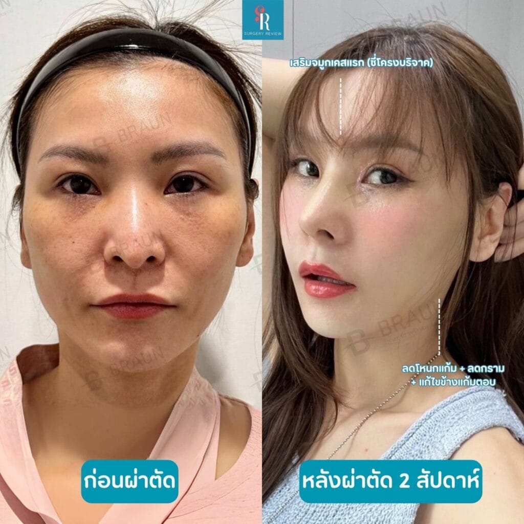 รีวิวศัลยกรรมรพ.บราวน์ จมูก+โครงหน้า