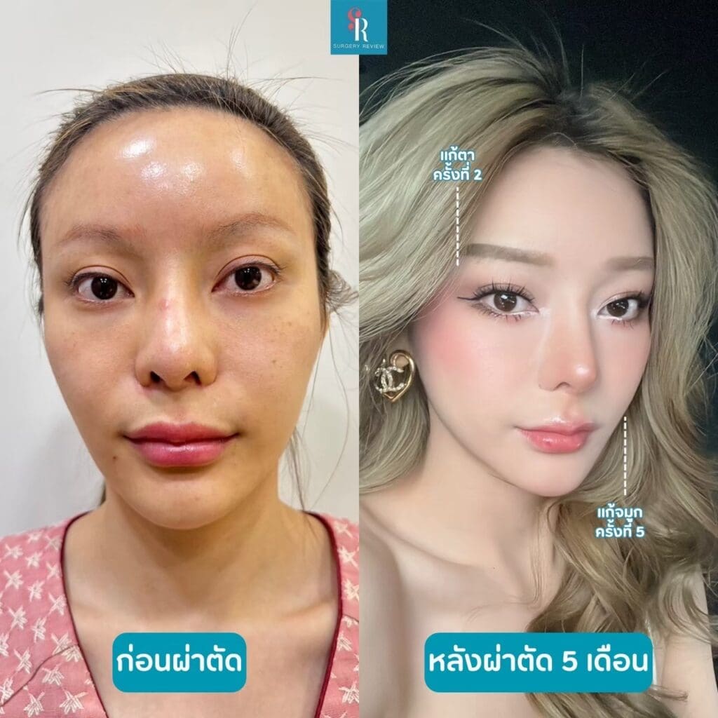 รีวิวศัลยกรรมรพ.บราวน์ ตา+จมูก