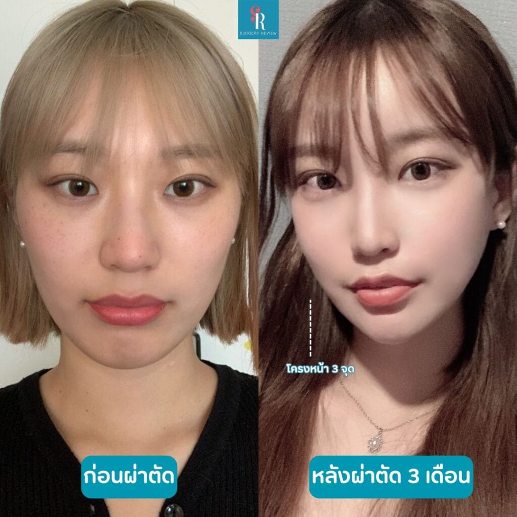 รีวิวทำโครงหน้า 1_ Plastic Surgery(1)