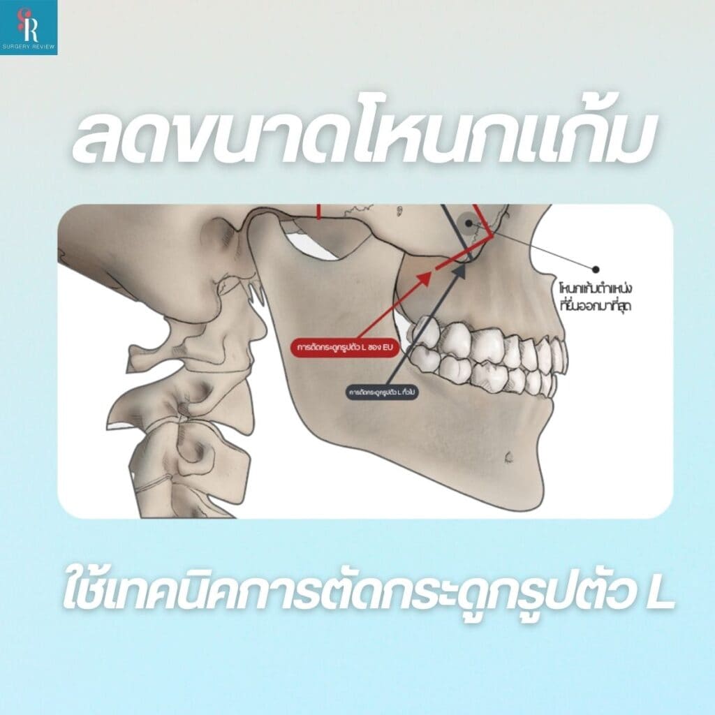 ลดขนาดโหนกแก้ม